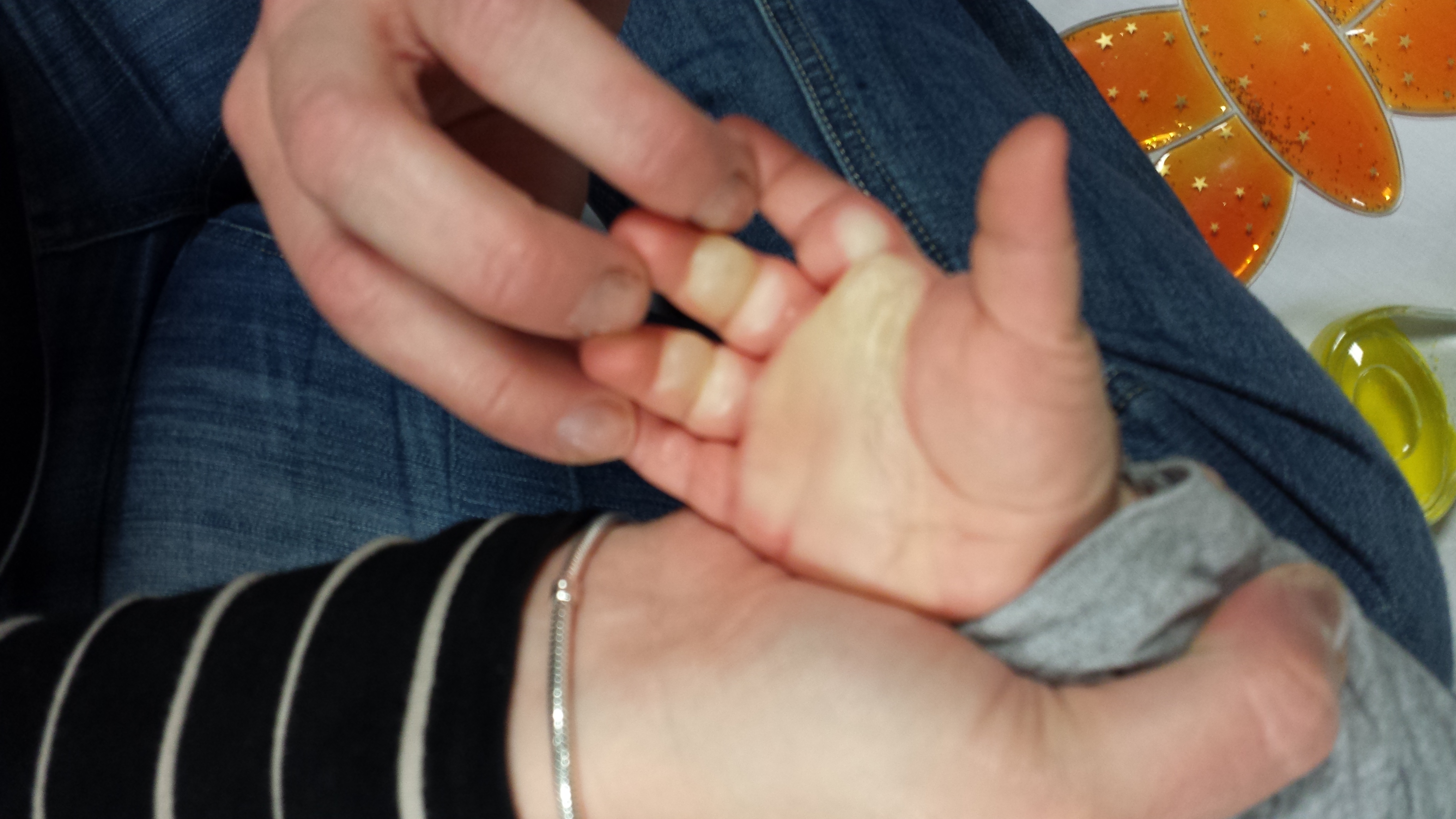 Todder's burnt hand